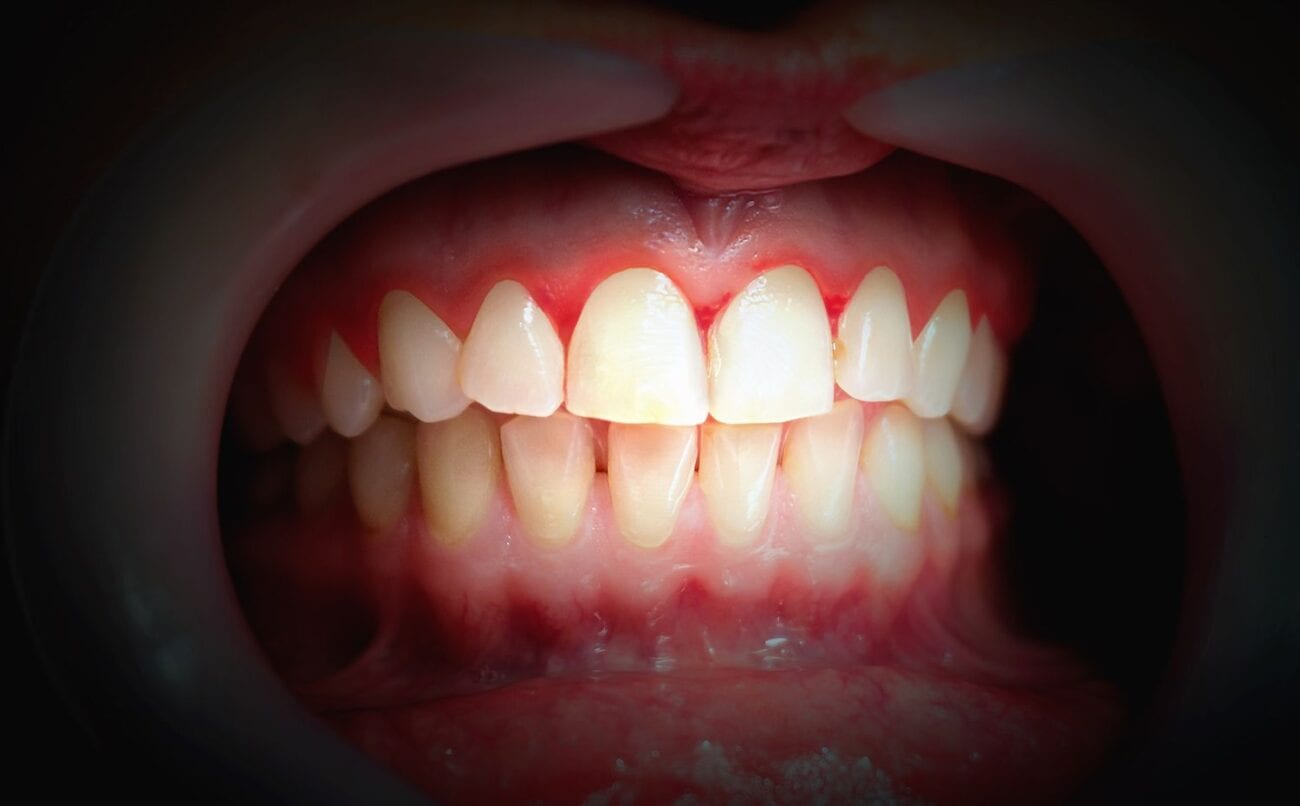 Why are My Gums Bleeding? Dentist in Washington DC