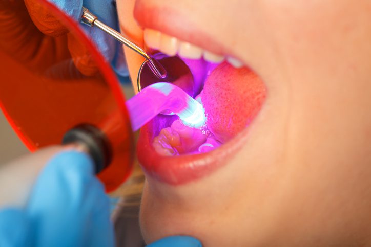Closeup of Woman receiving dental bonding treatment Cosmetic dentistry dentist in Washington DC