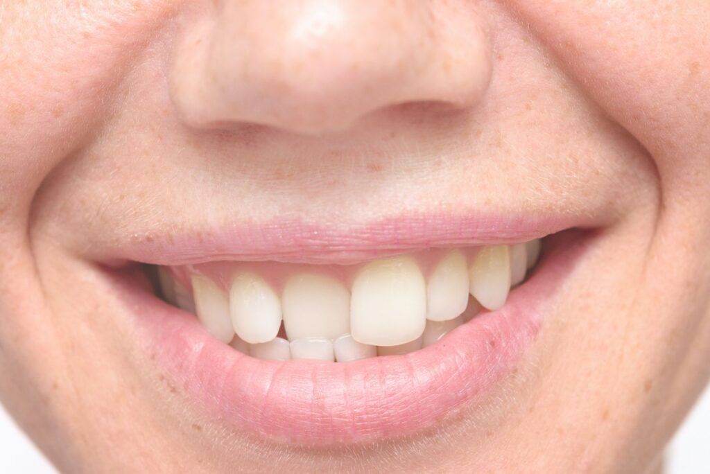 Close up shot of crooked teeth oral health cosmetic dentistry dentist in Washington DC