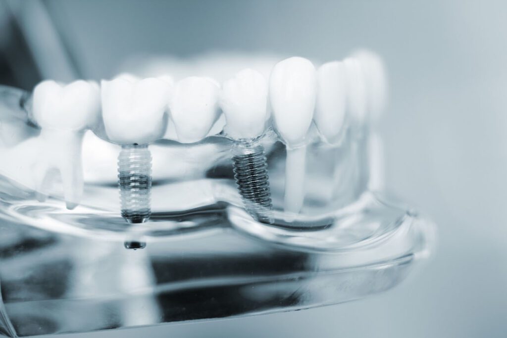 DENTAL IMPLANTS in WASHINGTON DC can help restore your bite after losing a tooth