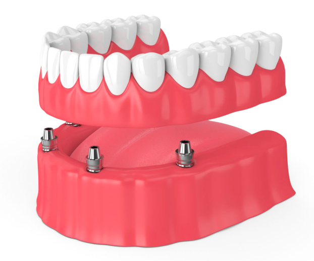 Dental implant-secured Denture