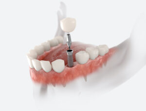 Am I a Candidate for Dental Implants? in Washington, DC